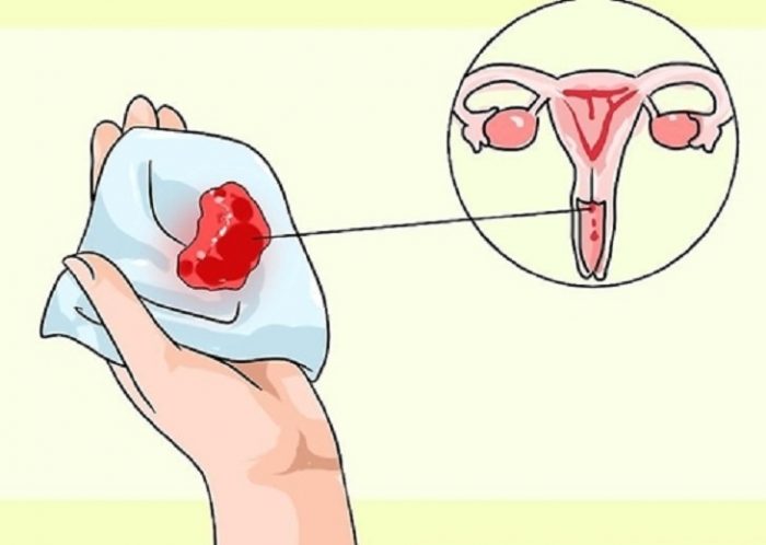 Biểu hiện của rong kinh sau hút thai